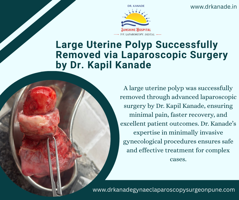 Large Uterine Polyp Successfully Removed via Laparoscopic Surgery in pune